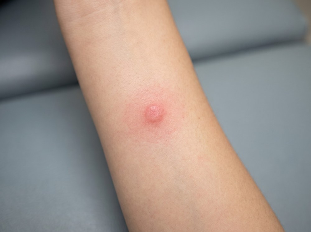 Close-up of a fresh red gallinipper mosquito bite welt with surrounding swelling on human skin a few hours after the bite